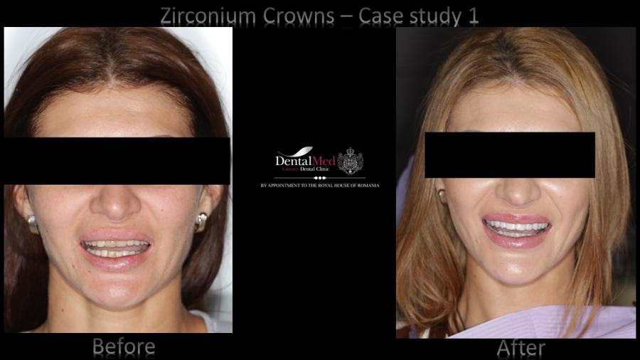 Zirconium%20Crowns%20case%201%20picture%201 Estetica dentara si protetica - coroana si proteza dentara