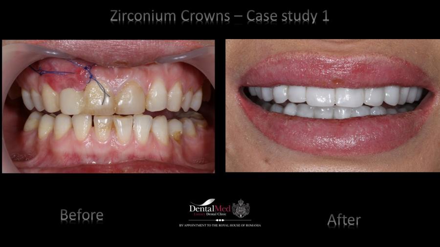 Zirconium%20Crowns%20case%201%20picture%202 Estetica dentara si protetica - coroana si proteza dentara