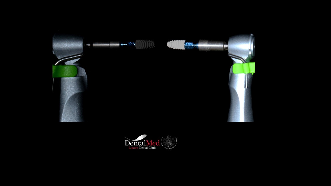 Implant dentar premium in Bucuresti 4 poza implant 2 Implant dentar premium in Bucuresti