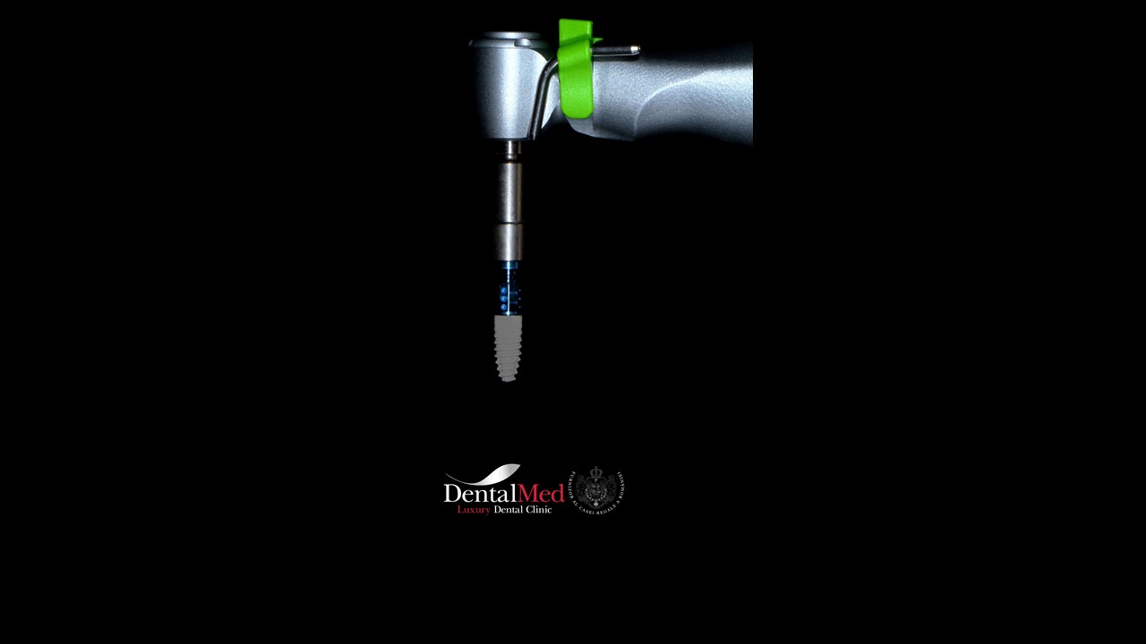 Implant dentar premium in Bucuresti 2 Implant dentar Straumann