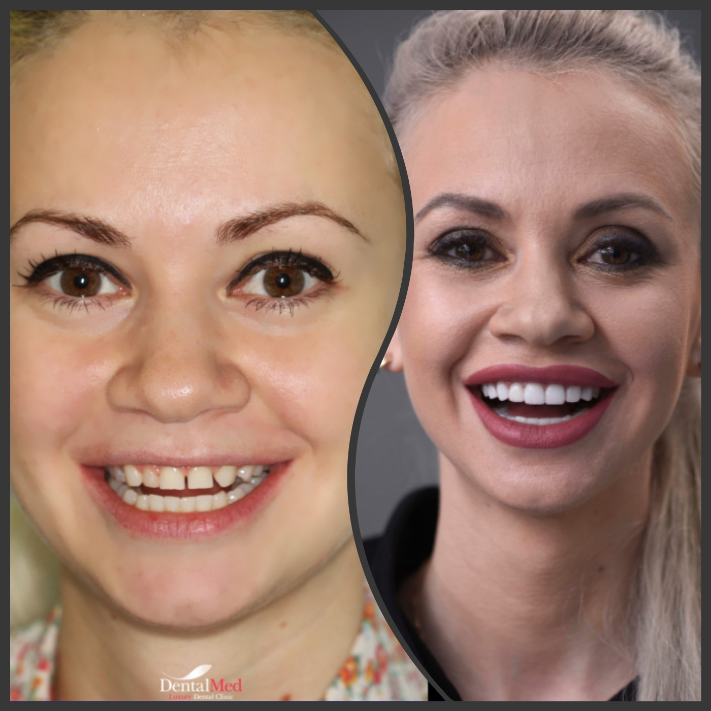 Fatete dentare portelan poze before & after