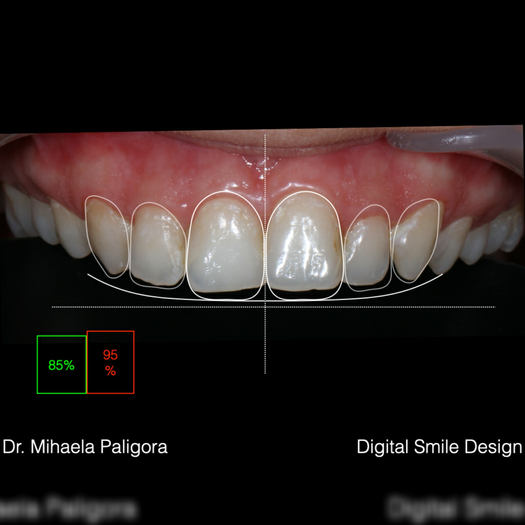 Fatete dentare Digital Smile Design (DSD)