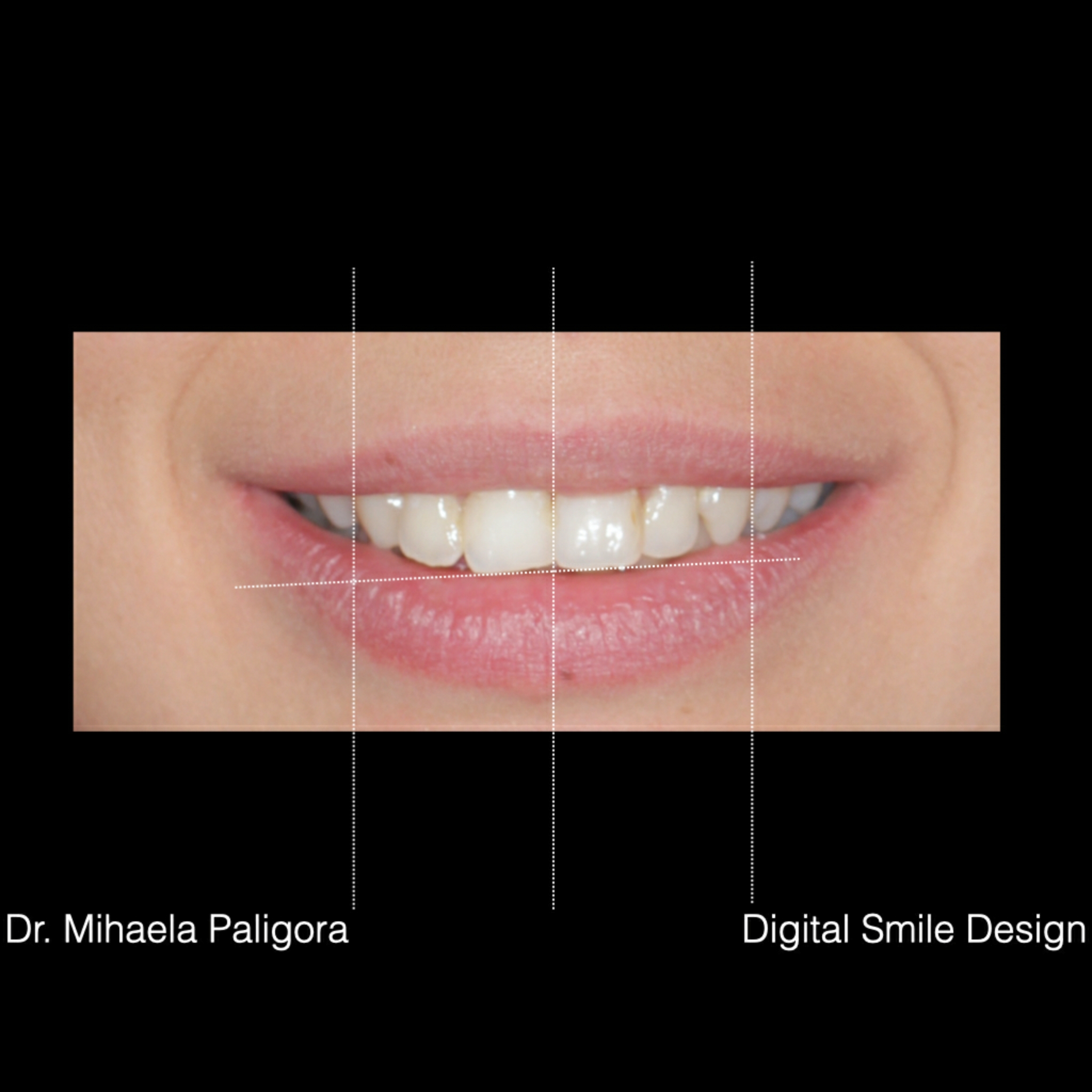 Digital Smile Design (DSD)