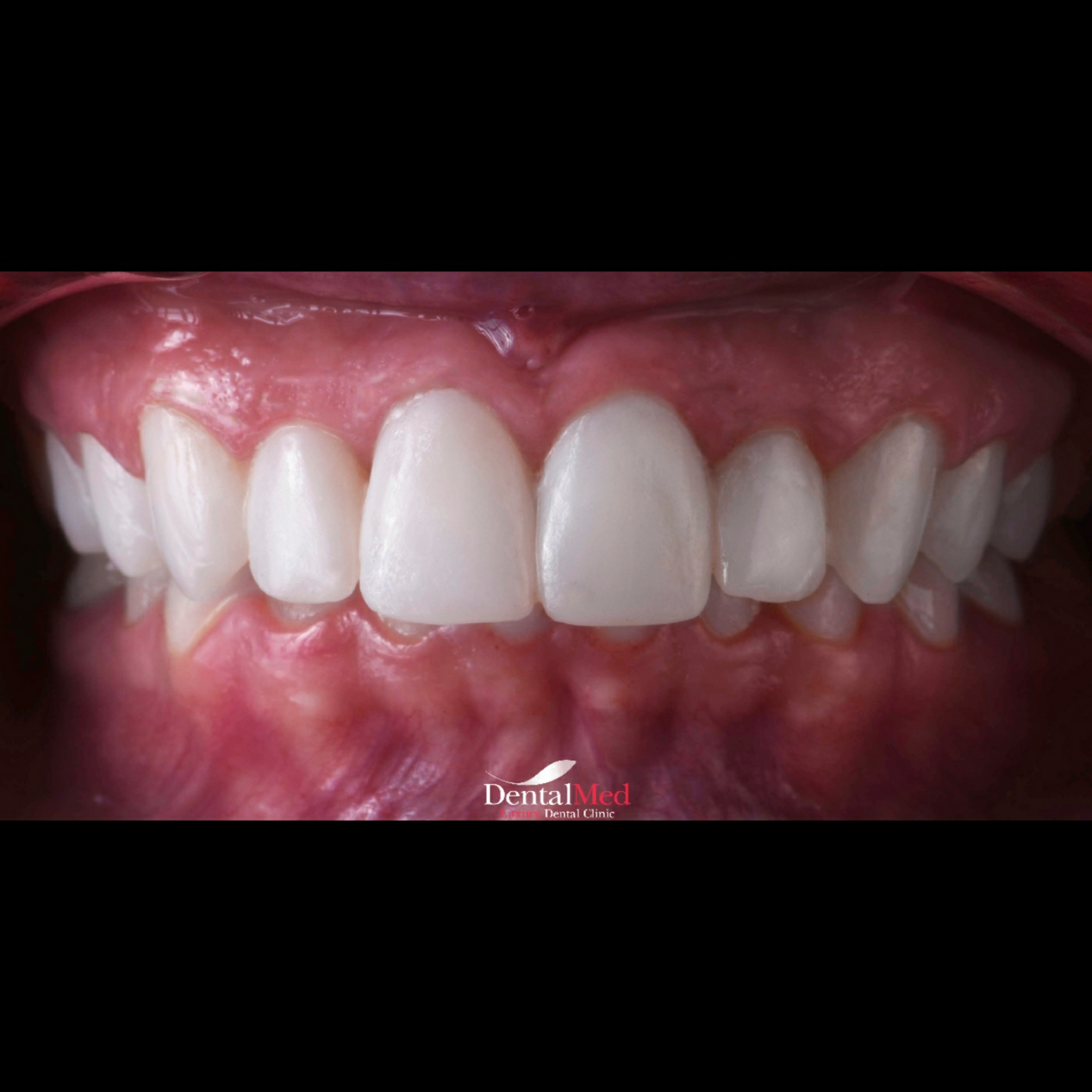 Fatete dentare Digital Smile Design (DSD)