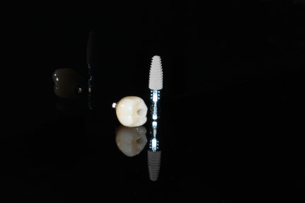 coroana dentara implant2 Implant dentar Bucuresti premium