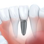 Implant dentar sau punte dentară? Iată cum alegi corect și detalii de care trebuie să ții cont când iei decizia 2 Implant dentar Bucuresti
