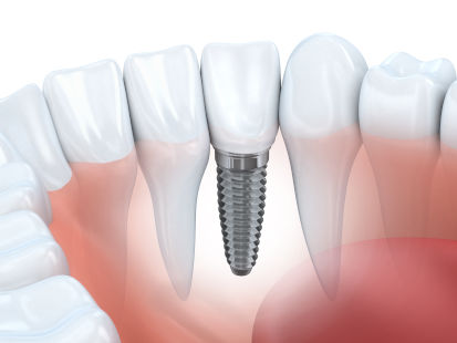 implant dentar bucuresti 1 Implant dentar premium in Bucuresti