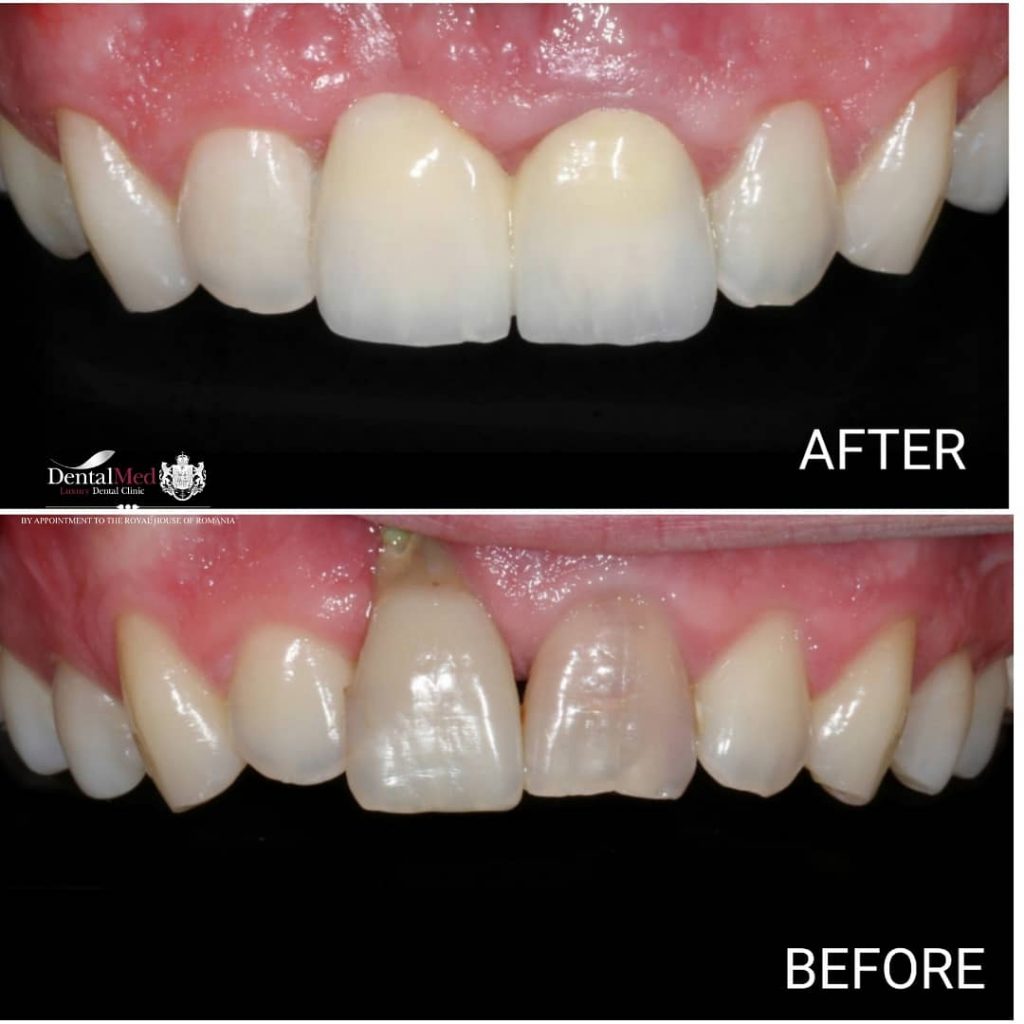 Emax Coroane dentare