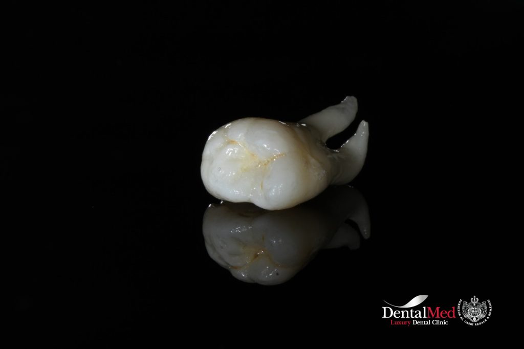 extractii dentare