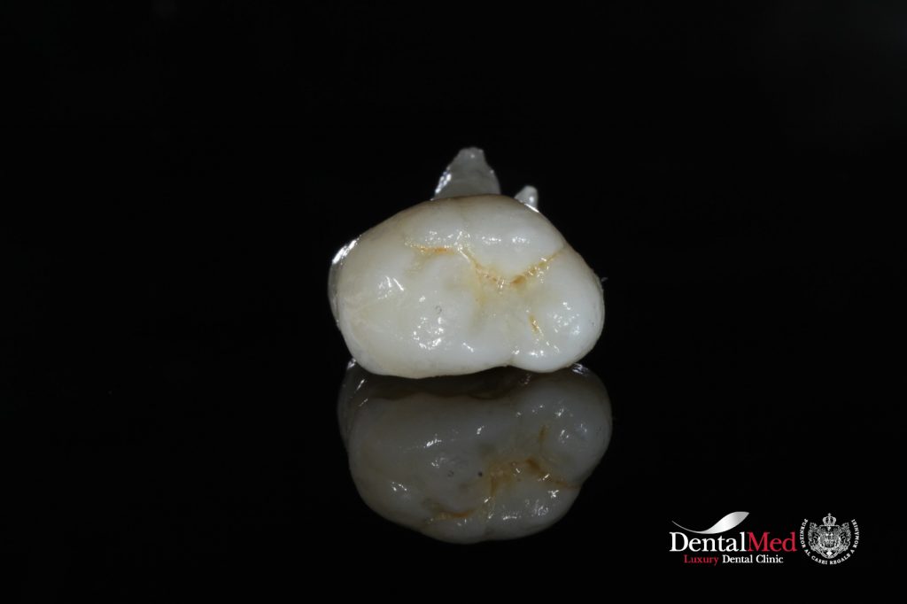 extractie dentara Extractiile dentare simple sau complexe
