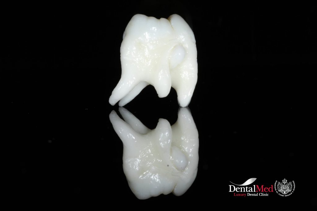 extractie dentara