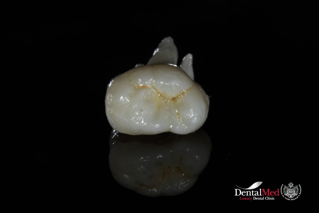 extractii dentare1 Extractiile dentare simple sau complexe