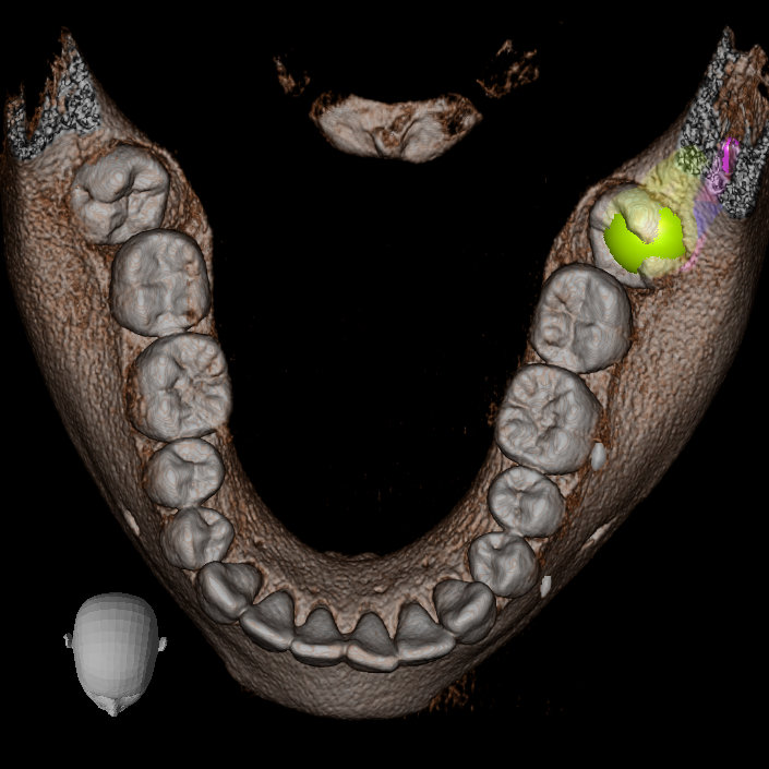 IMG 20210629 WA0015 Extractiile dentare simple sau complexe