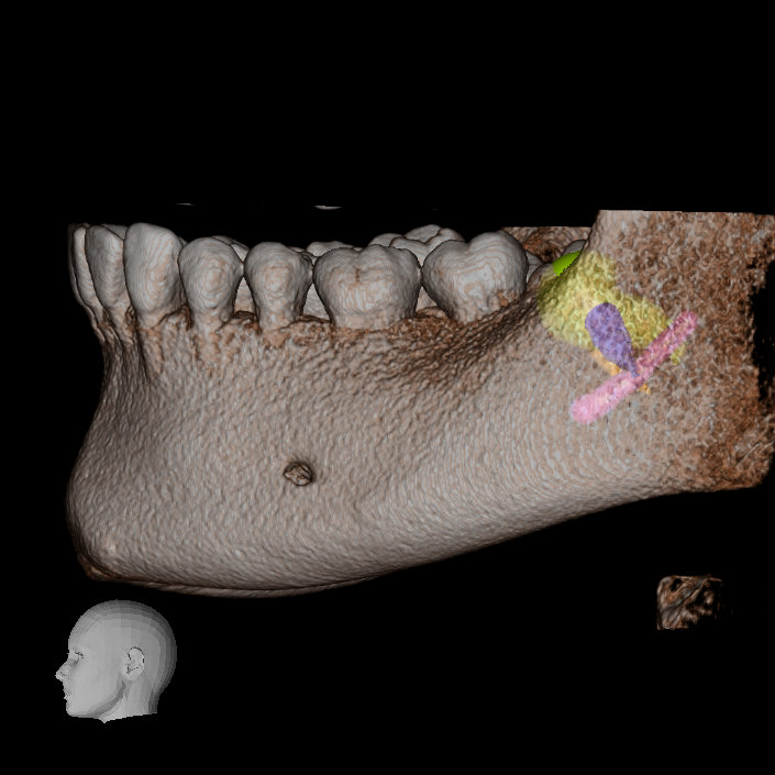 IMG 20210629 WA0019 Extractiile dentare simple sau complexe