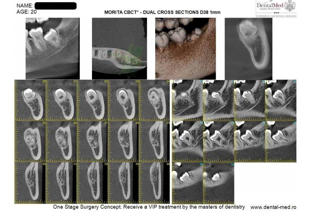 IMG 20210629 WA0020 Extractiile dentare simple sau complexe