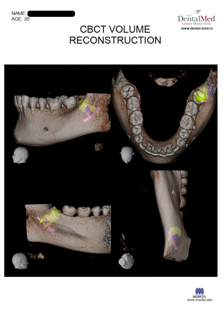 IMG 20210629 WA0021 Extractiile dentare simple sau complexe