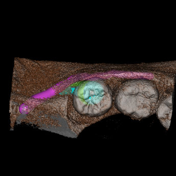 IMG 20210629 WA0022 Extractiile dentare simple sau complexe