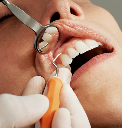 procedura detartraj Detartraj cu ultrasunete profesional