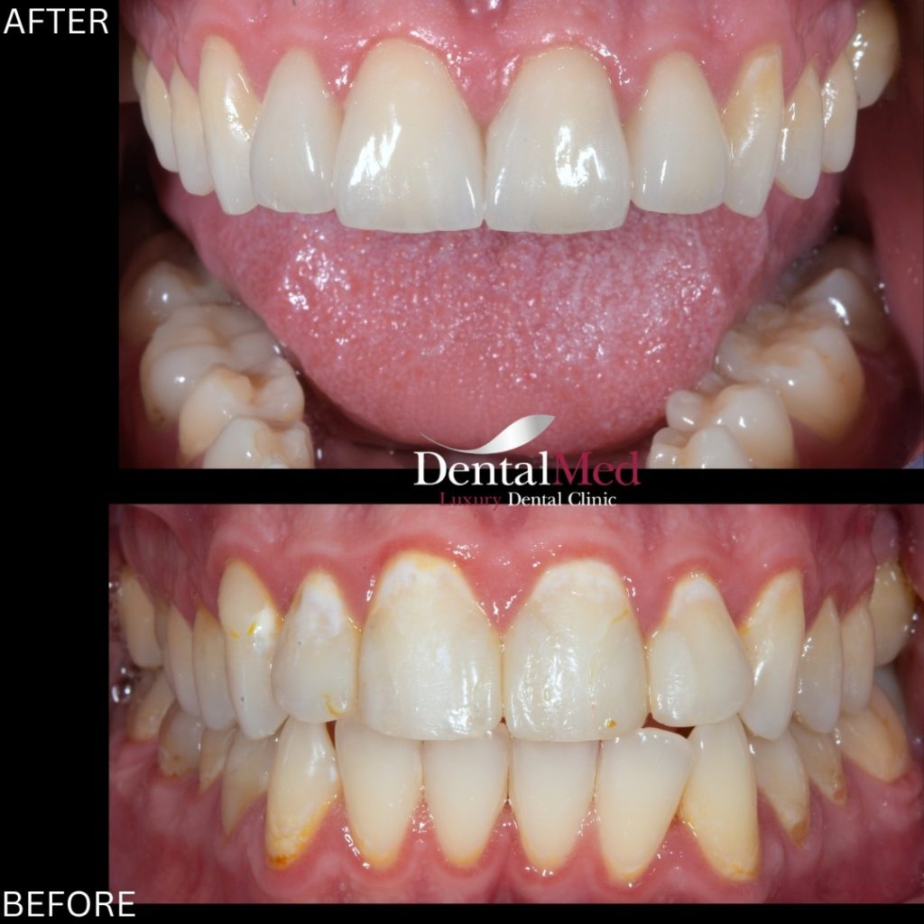 2 5 Fatete dentare in Bucuresti