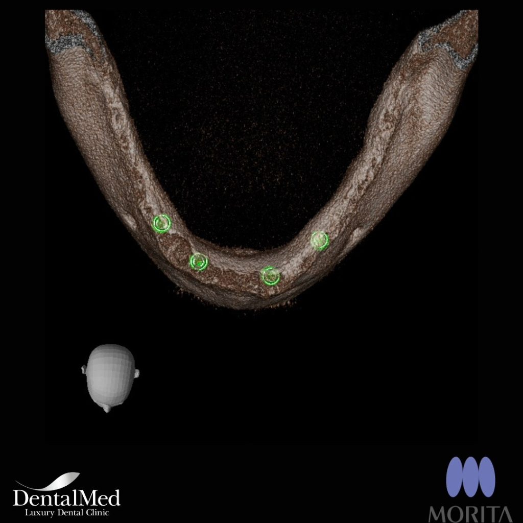 432459498 721746500080077 3469887338134497706 n Implant dentar Bucuresti premium