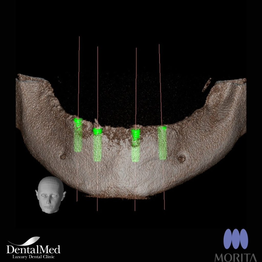 432463209 721746496746744 7153394507784834257 n Implant dentar premium in Bucuresti