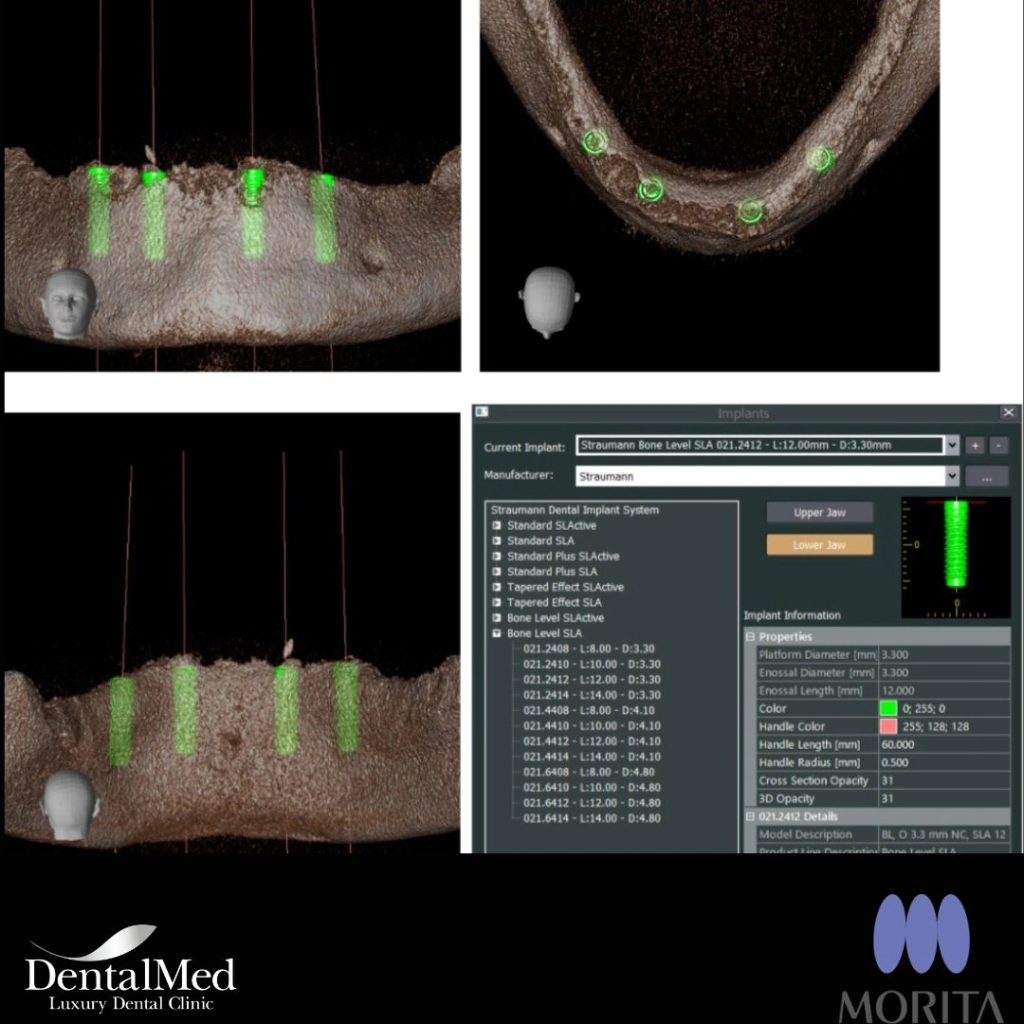 432472258 721746493413411 6132389302905564304 n Implant dentar Bucuresti premium