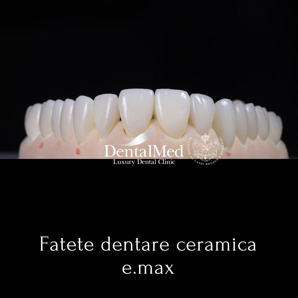 fatete dentare ceramica e.max Adevărul despre Fatetele Dentare Universale disponibile în Farmacii si Magazine Online