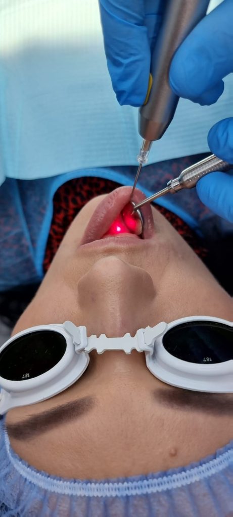 frenectomie laser bucuresti copii Frenectomie Linguala cu Laser: Ghid Complet