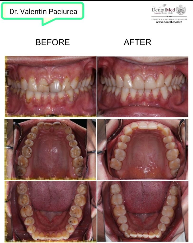 Obturatii Before & After