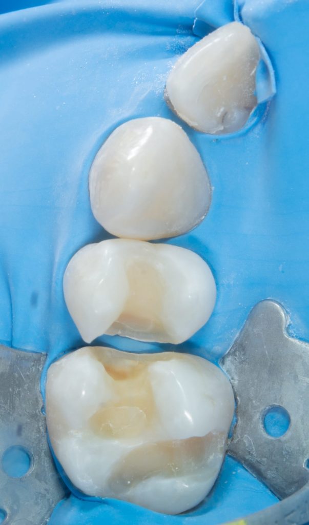 WhatsApp Image 2024 04 03 at 16.21.36 1 Plombe Dentare: O Abordare Modernă Pentru Sănătatea ta Dentară