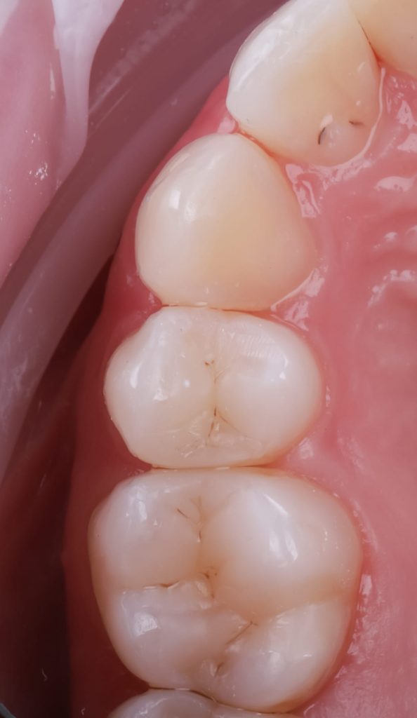 WhatsApp Image 2024 04 03 at 16.21.36 Plombe Dentare: O Abordare Modernă Pentru Sănătatea ta Dentară