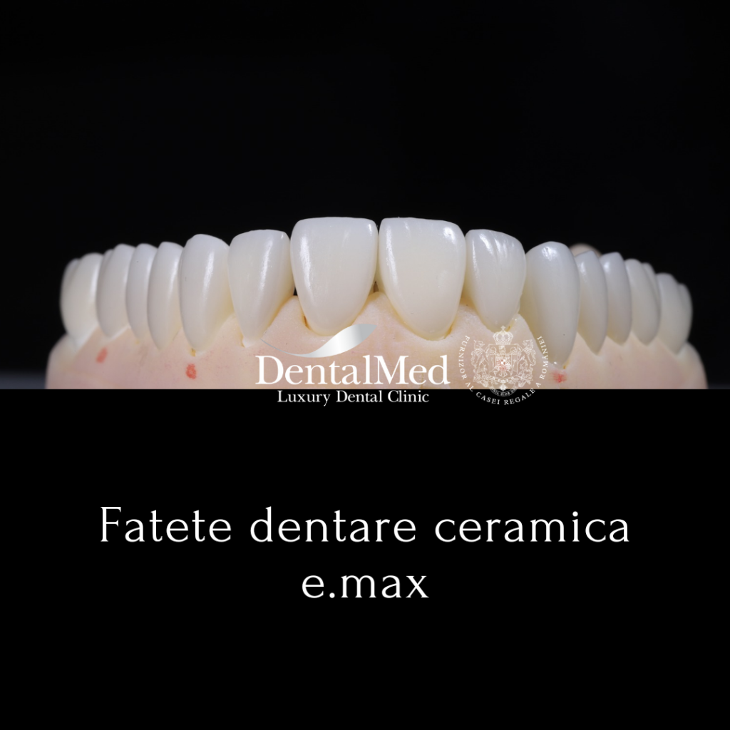 fatete dentare ceramica Fatete dentare din compozit fara slefuire versus fatete ceramice