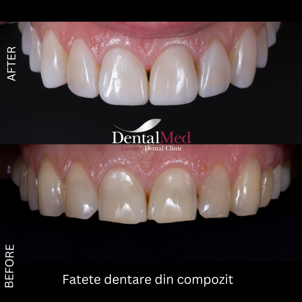 fatete dentare compozit studiu caz Fatete dentare din compozit fara slefuire versus fatete ceramice