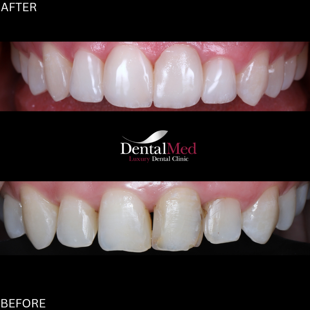 fatete dentare compozit studiu de caz 1 Fatete dentare din compozit fara slefuire versus fatete ceramice