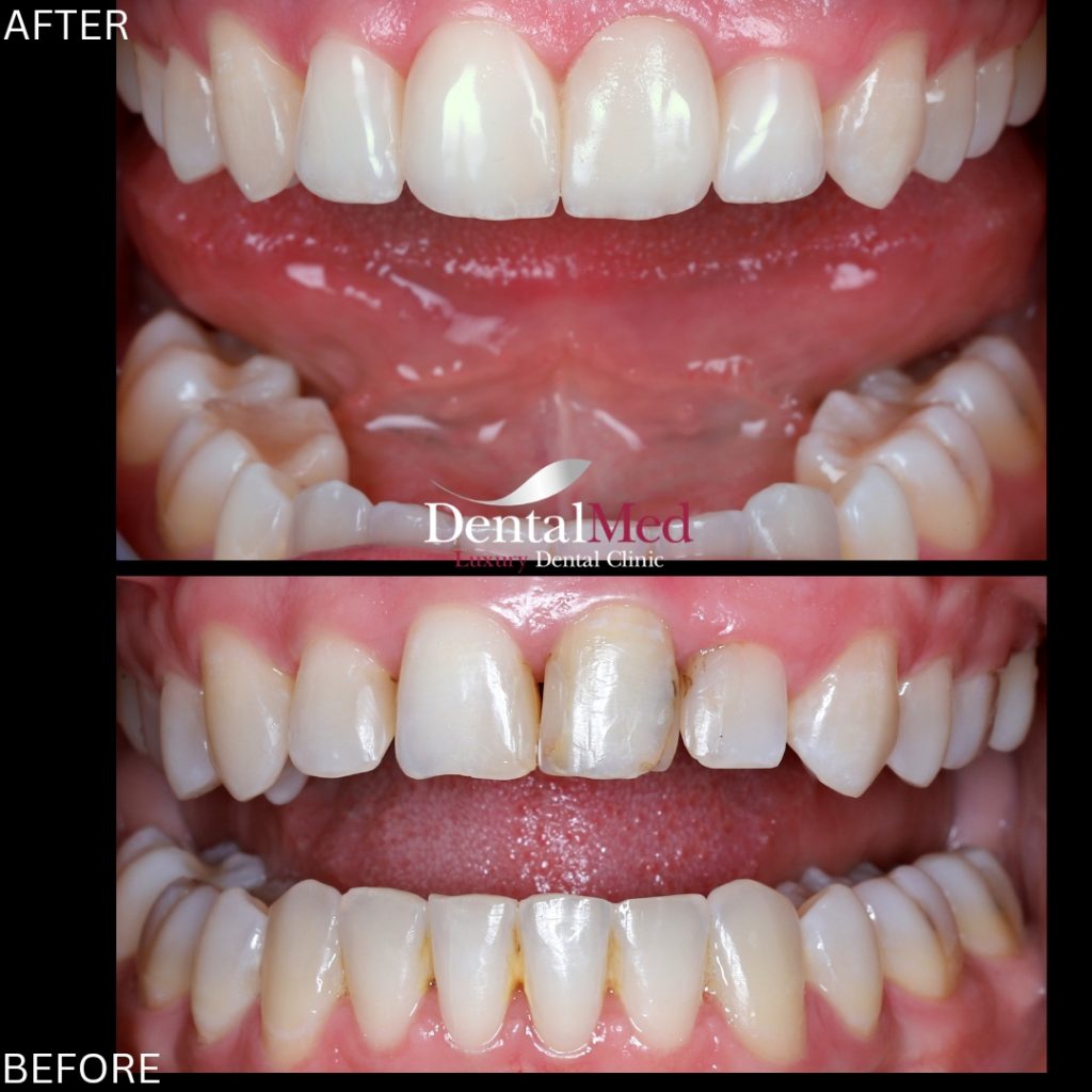 fatete dentare compozit1 Fatete dentare din compozit fara slefuire versus fatete ceramice