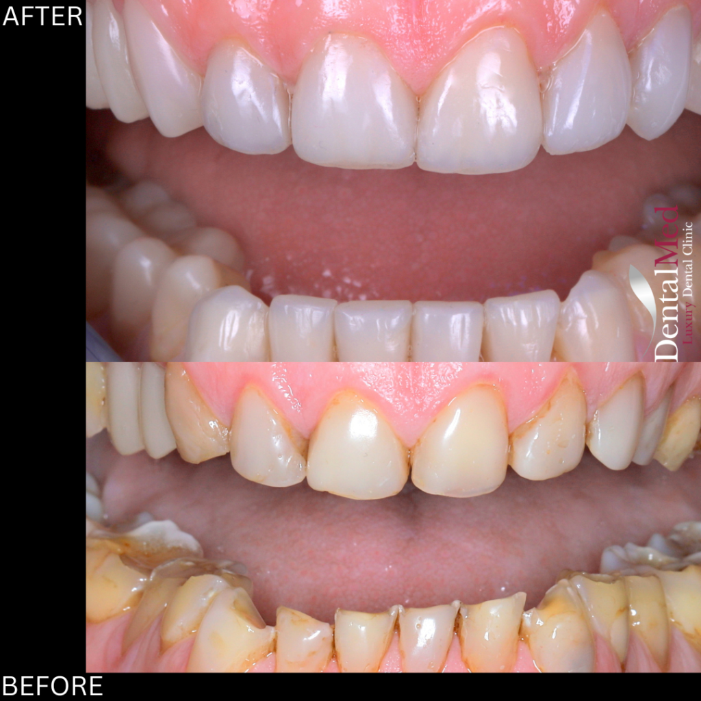 studiu de caz 2 Fatete dentare din compozit fara slefuire versus fatete ceramice