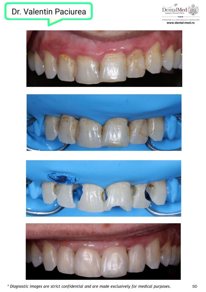 tratarea cariilor dentare Bucuresti