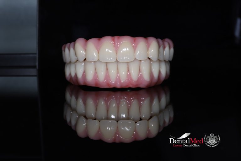 dinti ficsi pe implant dentar Dinti ficsi pe implant dentar