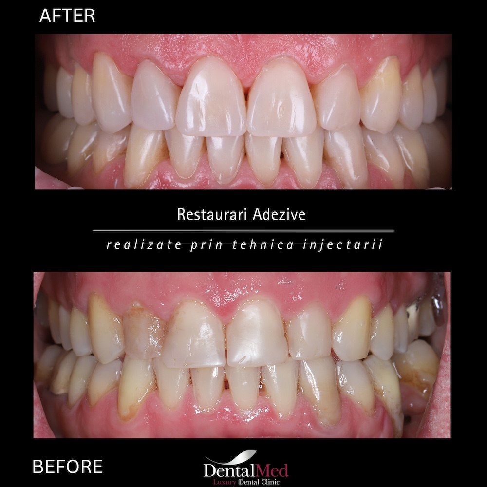 restaurari1 Plombe Dentare Moderne