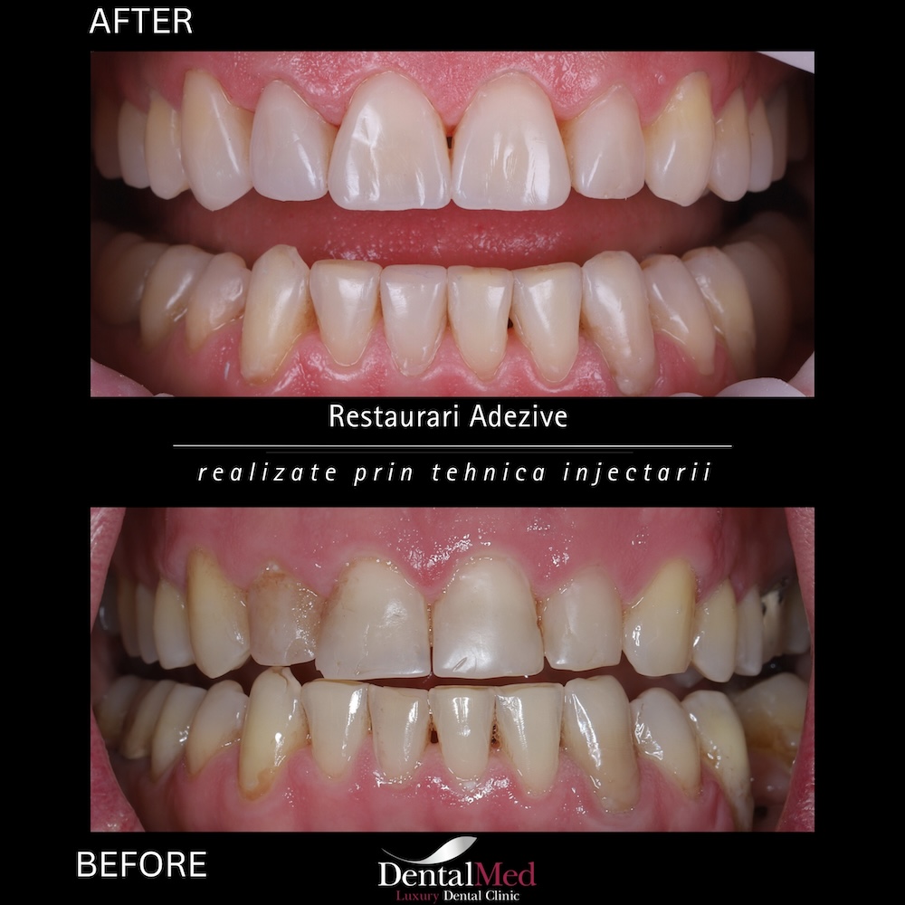 restaurari2 Plombe Dentare Moderne
