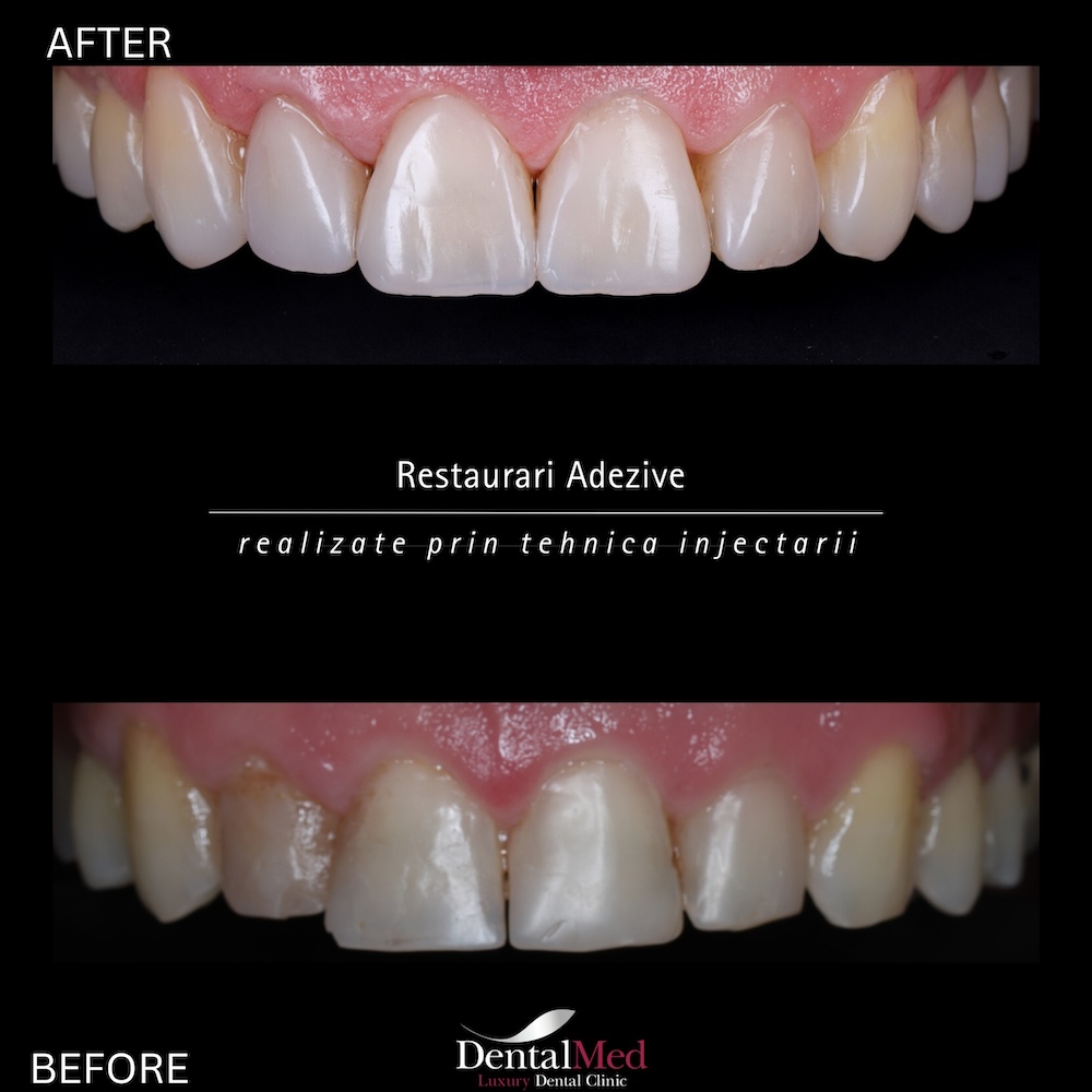 restaurari3 Plombe Dentare Moderne