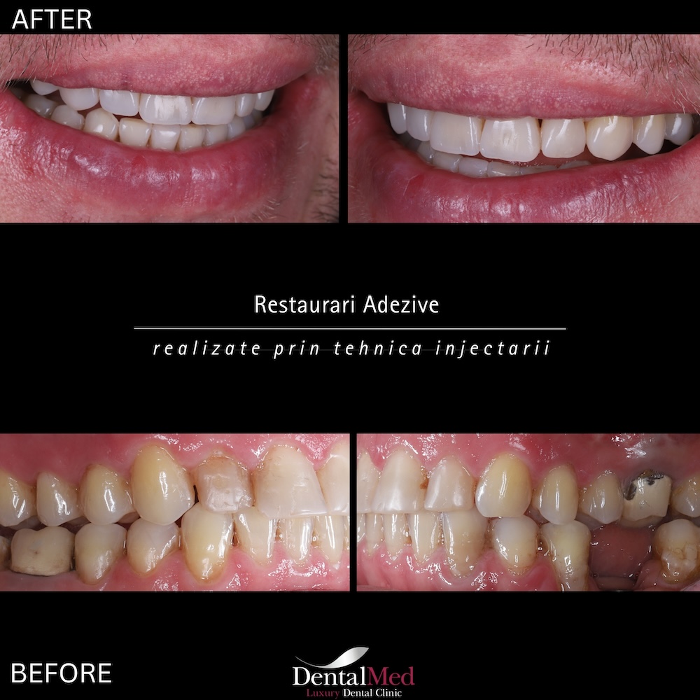 restaurari4 Plombe Dentare Moderne