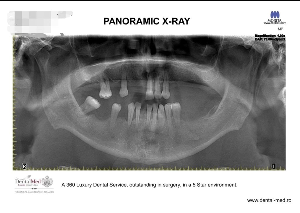 implant dentar procedura Implant dentar – procedura conform conceptului inovativ One Stage Surgery