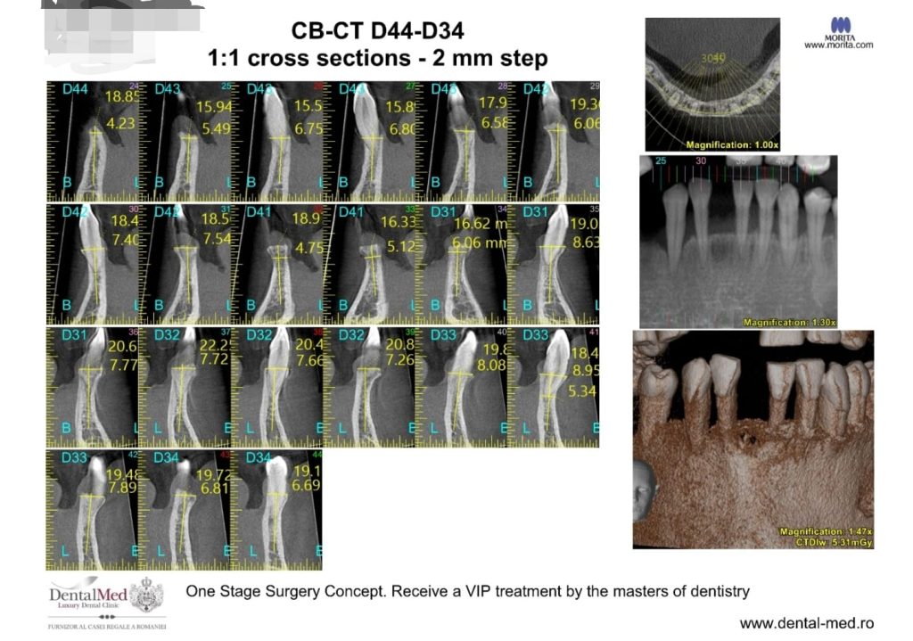 one stage surgery Implant dentar – procedura conform conceptului inovativ One Stage Surgery