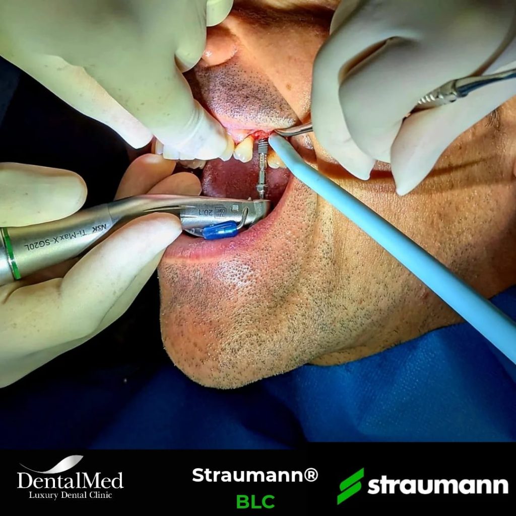 Implant dentar Straumann BLC