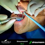 Implant dentar Straumann BLC