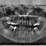 radiografiile dentare sunt periculoase fals
