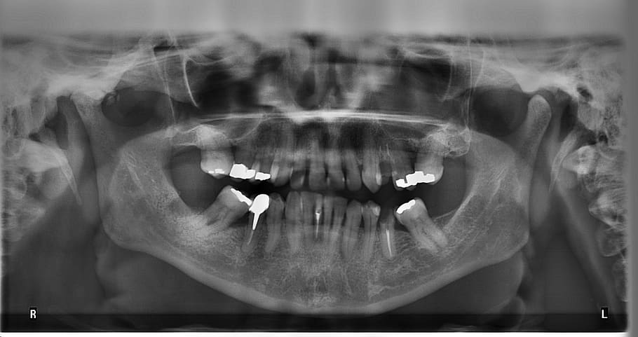 Radiografiile dentare sunt periculoase? Raspunsul nostru: un NU categoric! 1 radiografiile dentare sunt periculoase fals