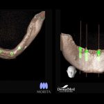 recuperare implant dentar