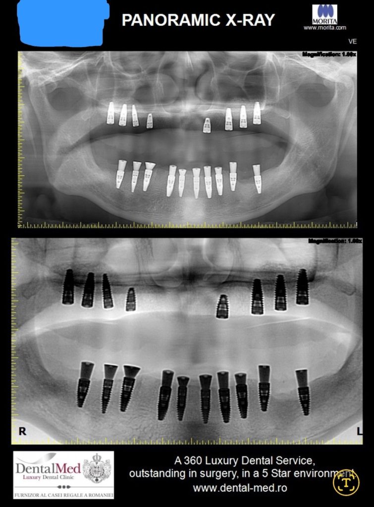 11.09 implantul dentar este periculos 2 Implantul dentar este periculos? Raspunsul medicilor este categoric NU!